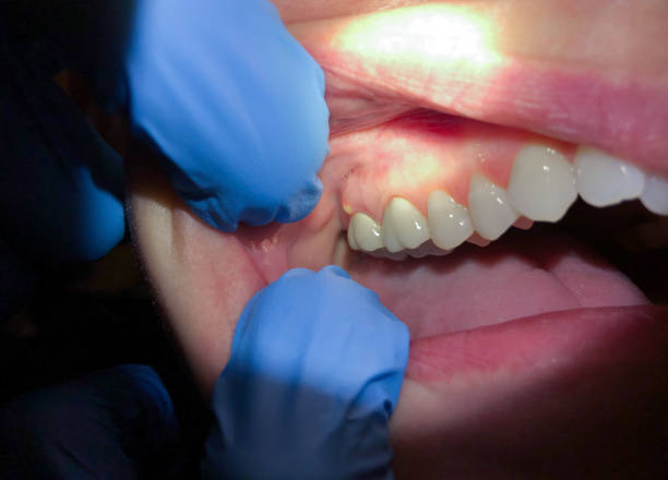 Best Emergency Cosmetic Dentistry (e.g., broken veneers) in Glen Lyon, PA